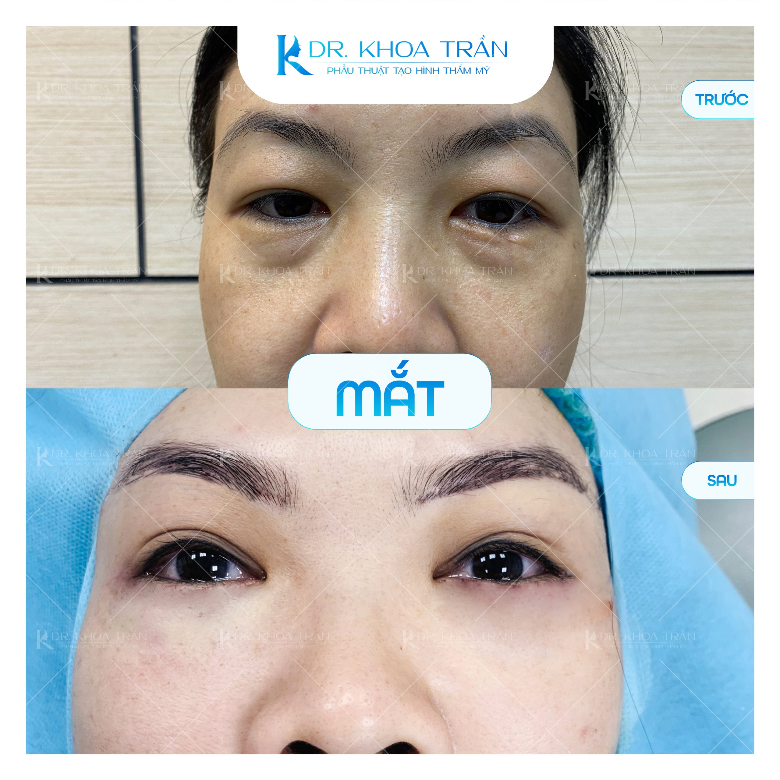 Cắt mí được thực hiện bởi Dr. Khoa Trần