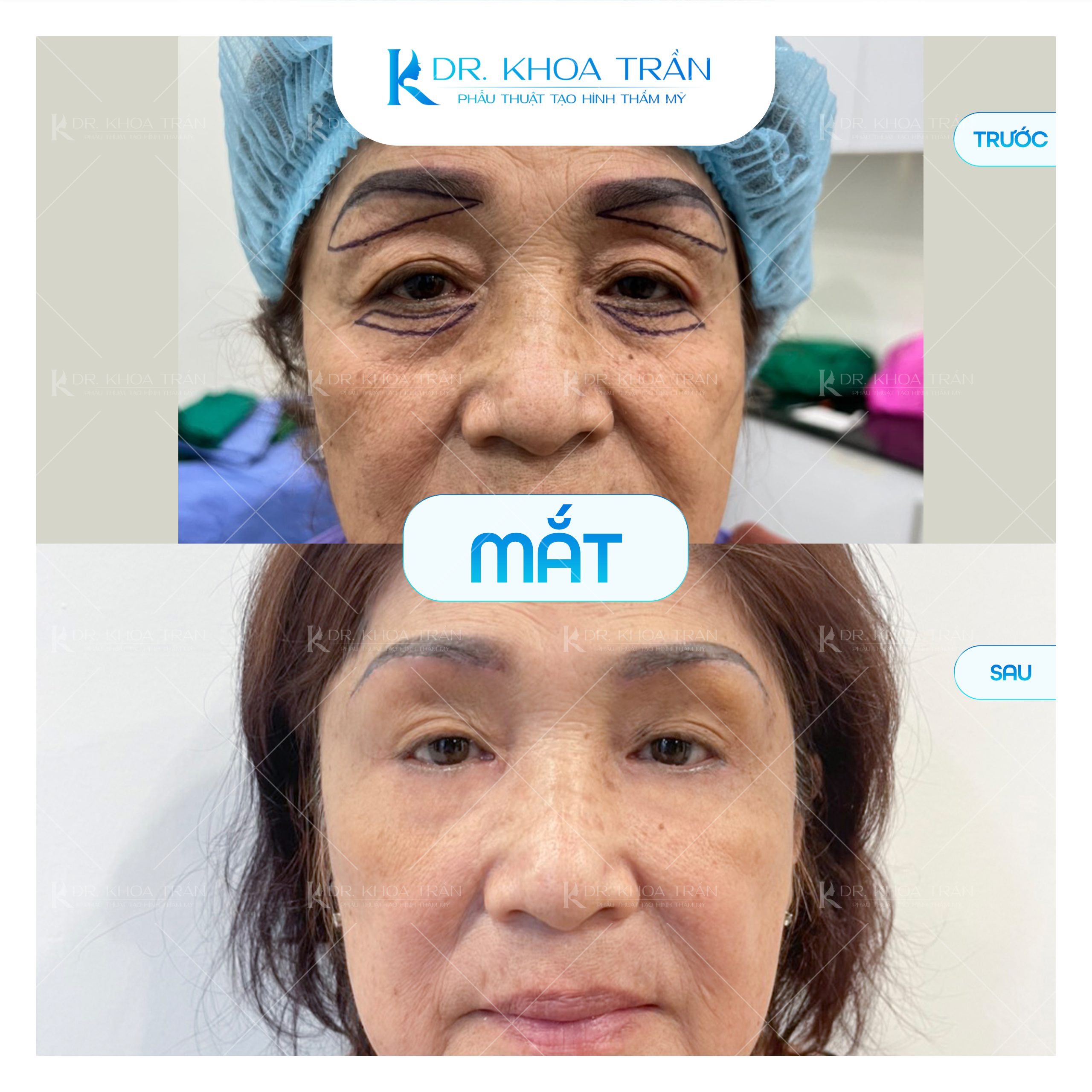 Trẻ hóa mí mắt trên và dưới