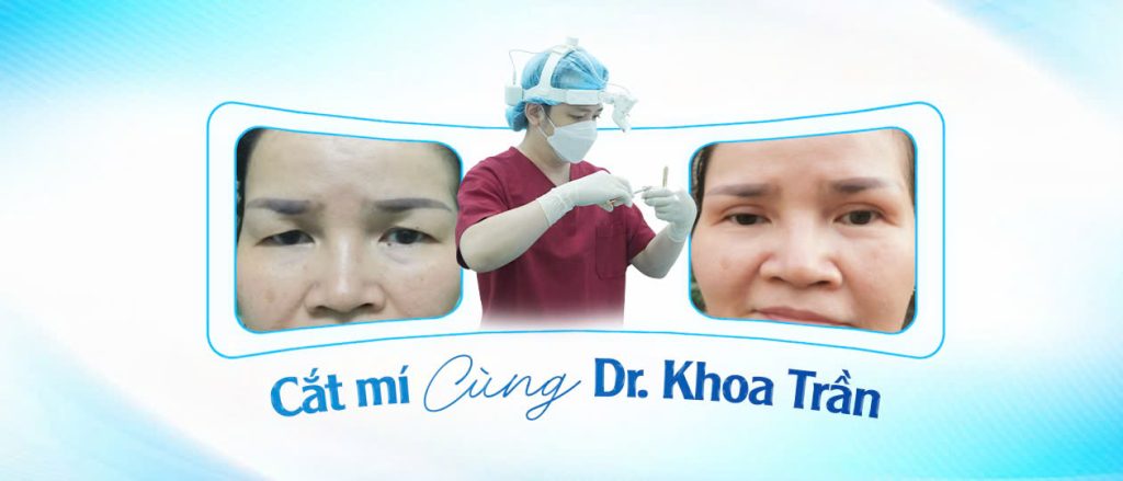 Cắt mí cùng Dr. Khoa Trần