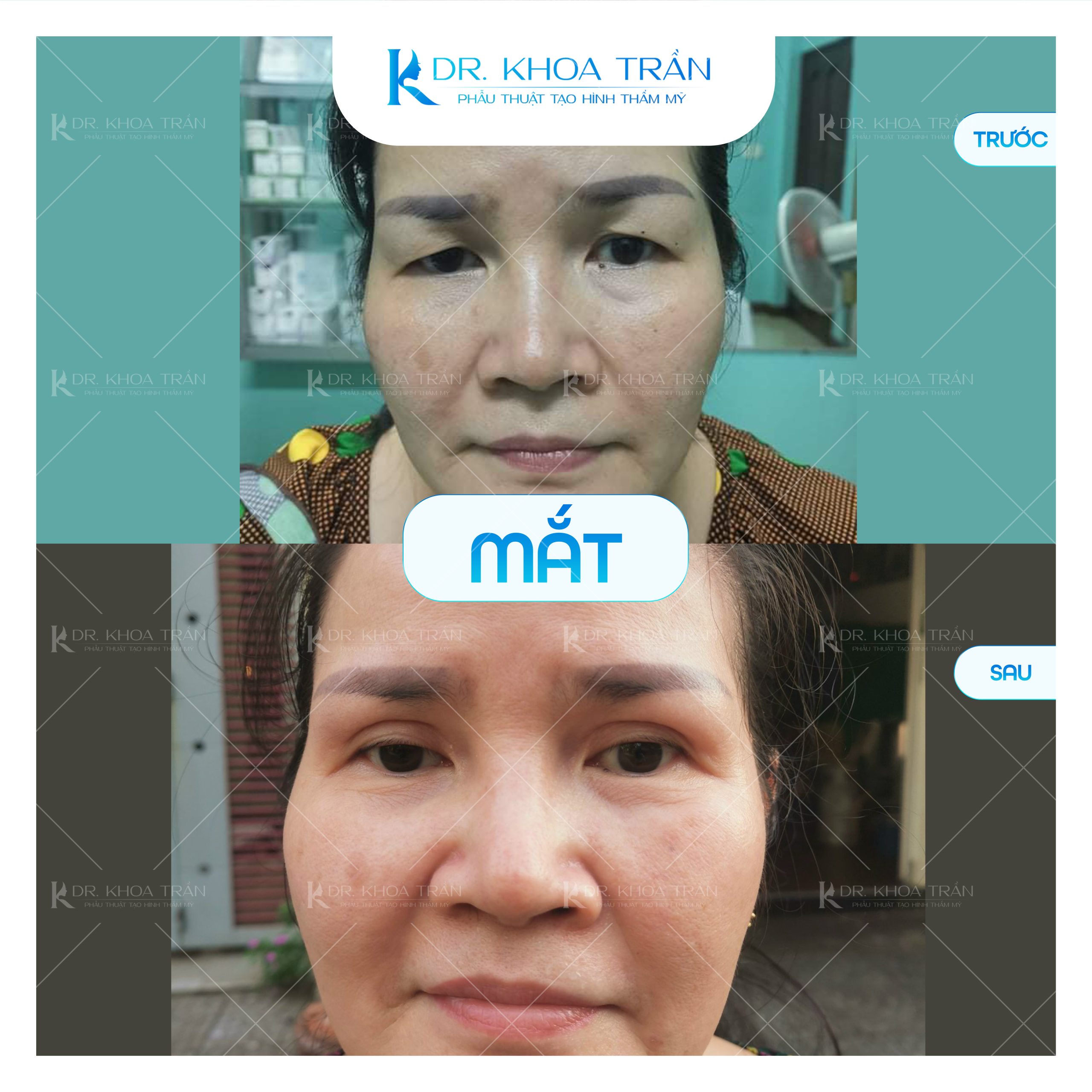 Cắt mí