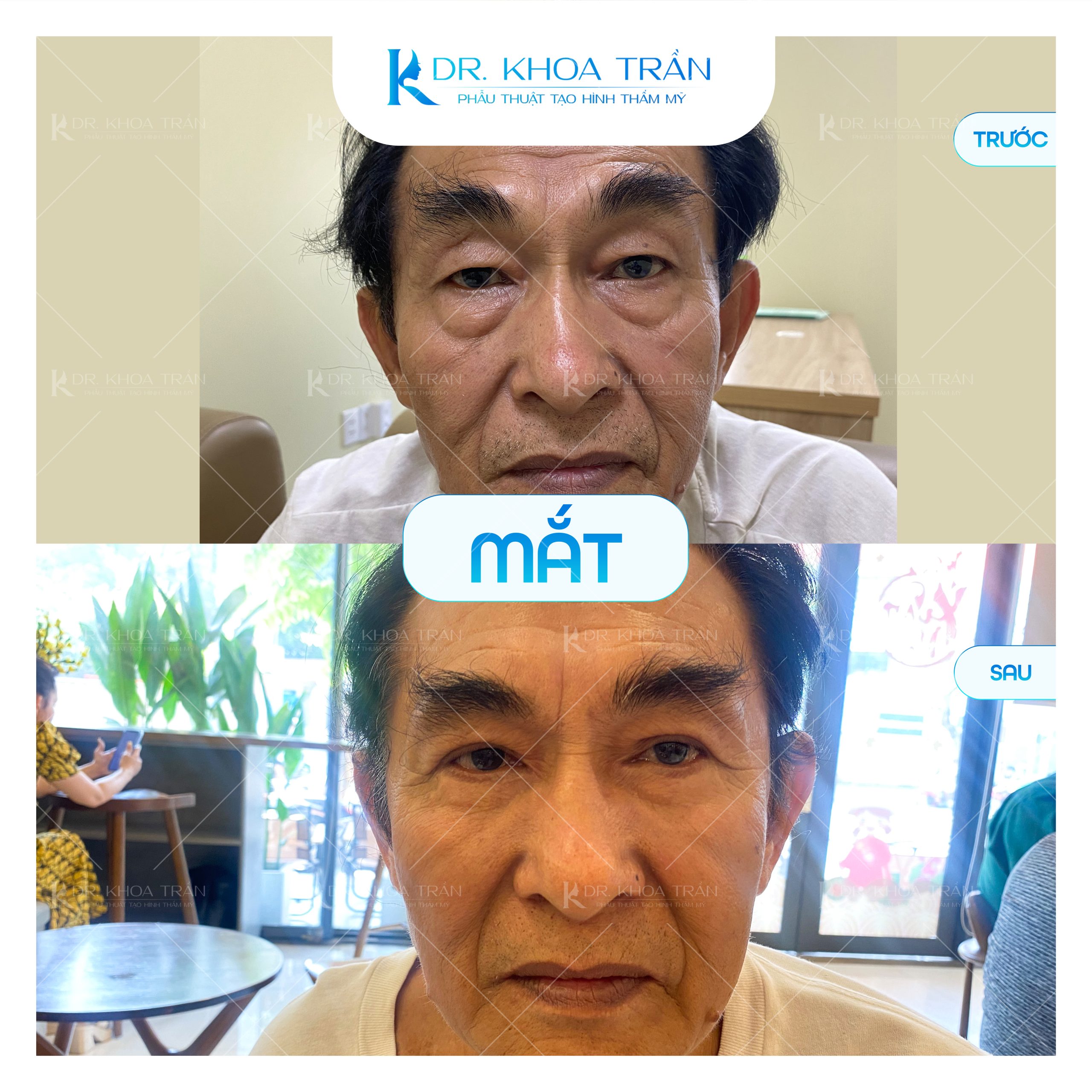Cắt mí và trẻ hóa mí mắt cùng Dr. Khoa Trần