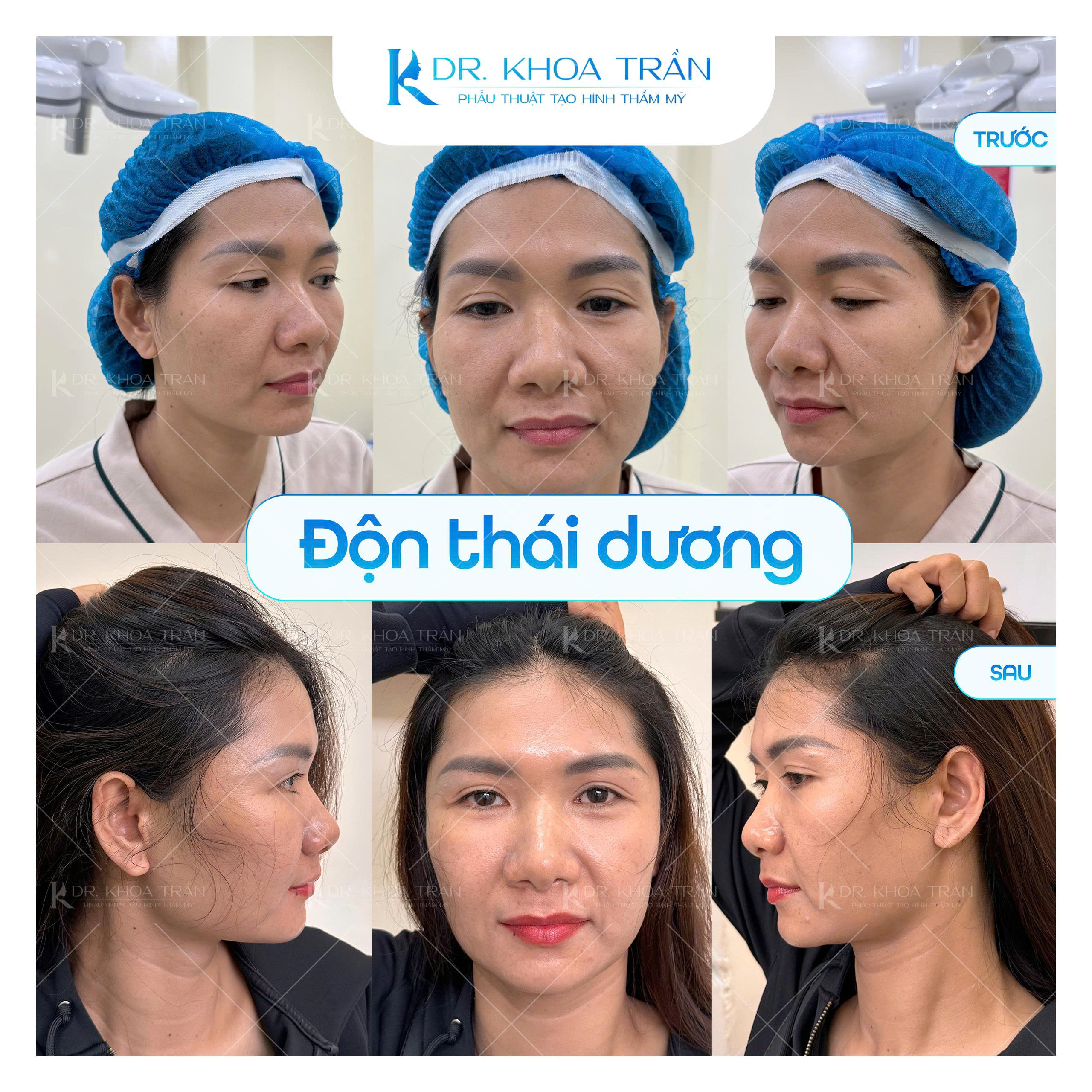 Khách hàng độn thái dương cùng Dr. Khoa Trần