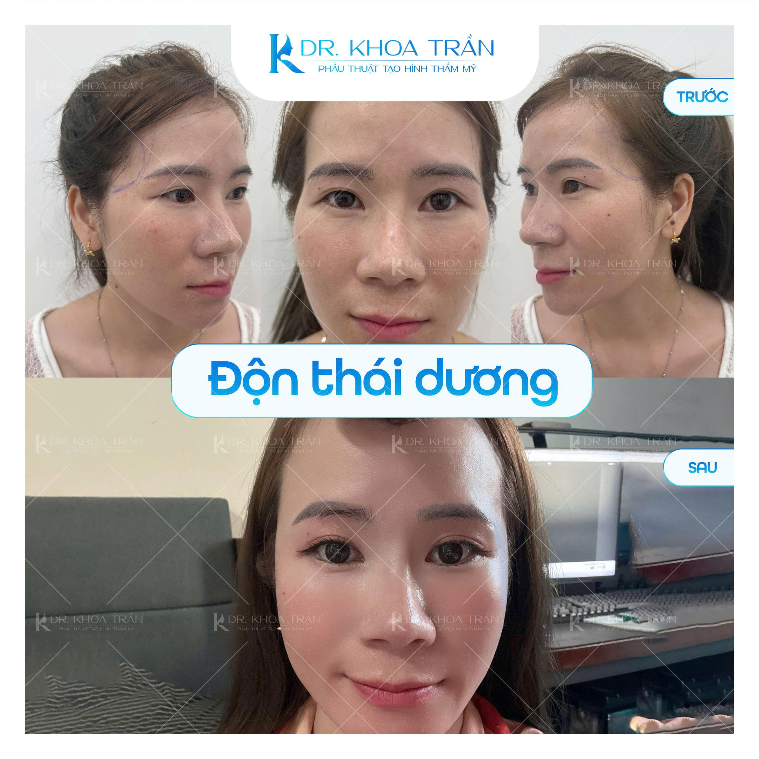 Kết quả độn thái dương cùng Dr. Khoa Trần
