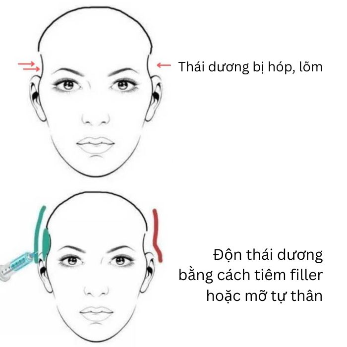 Mô phỏng làm đầy hỏm thái dương băng cách tiêm filler hoặc mỡ tự thân