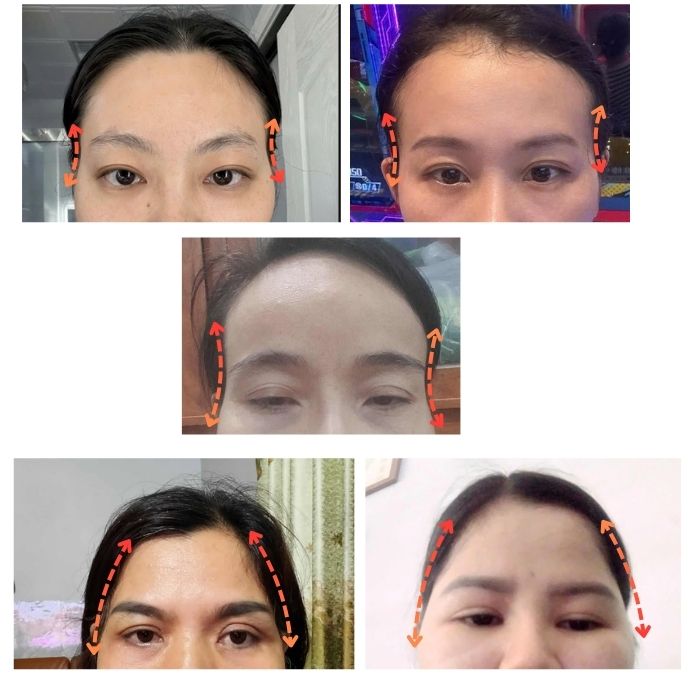 Một số trường hợp nên làm đầy hõm thái dương (nguồn internet)
