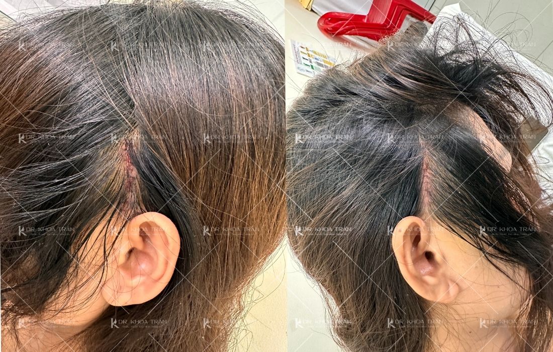 Vị trí vết sẹo khi độn thái dương cùng Dr. Khoa Trần